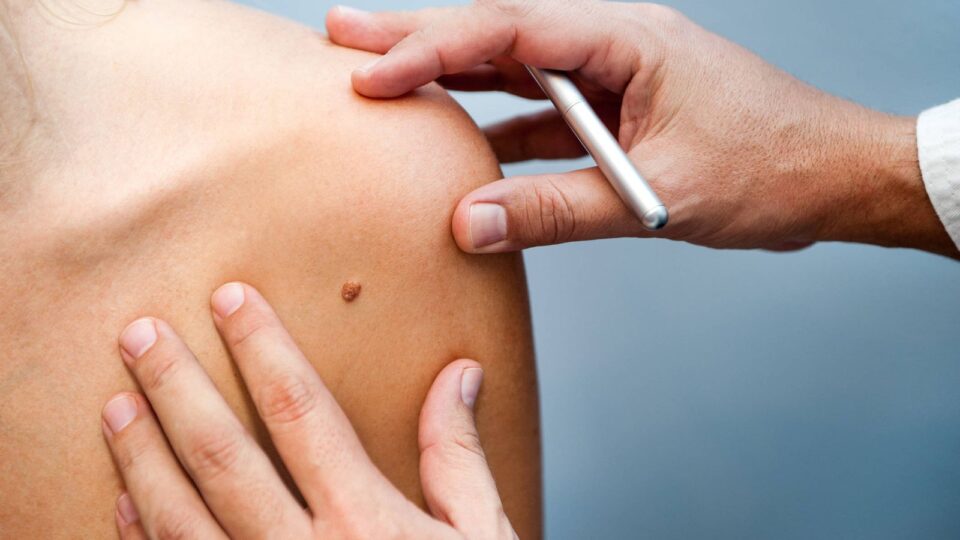 Hoy 23 de mayo, Día Mundial contra el Melanoma