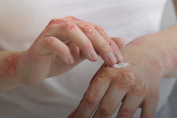 Hoy 14 de septiembre, Día Mundial de la Dermatitis Atópica
