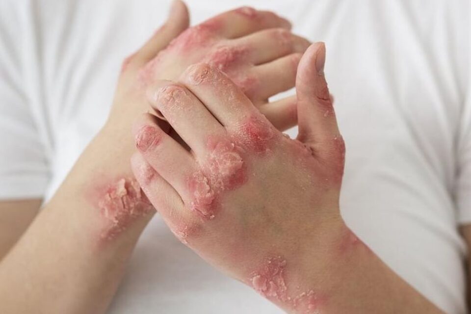 Hoy 29 de octubre, Día Mundial de la Psoriasis 