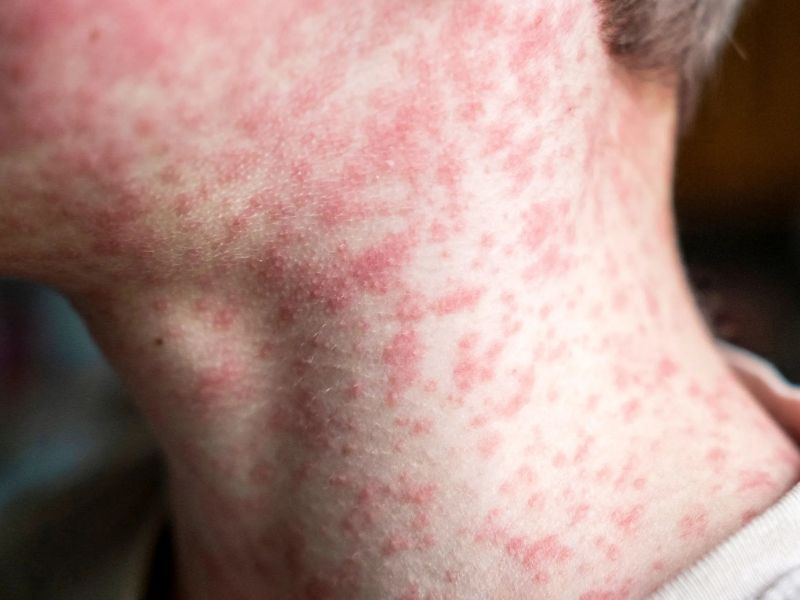 Un colectivo con contagiados de sarampión pasó por Jujuy 