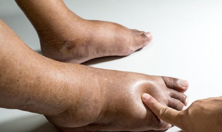 Hoy 6 de marzo, Día Internacional del Linfedema