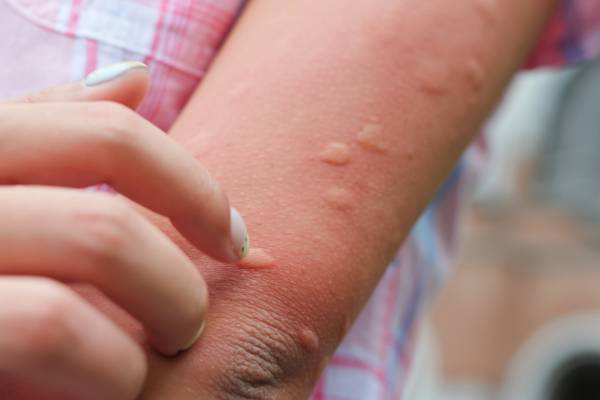 Confirman 33 casos de Chikungunya en Jujuy