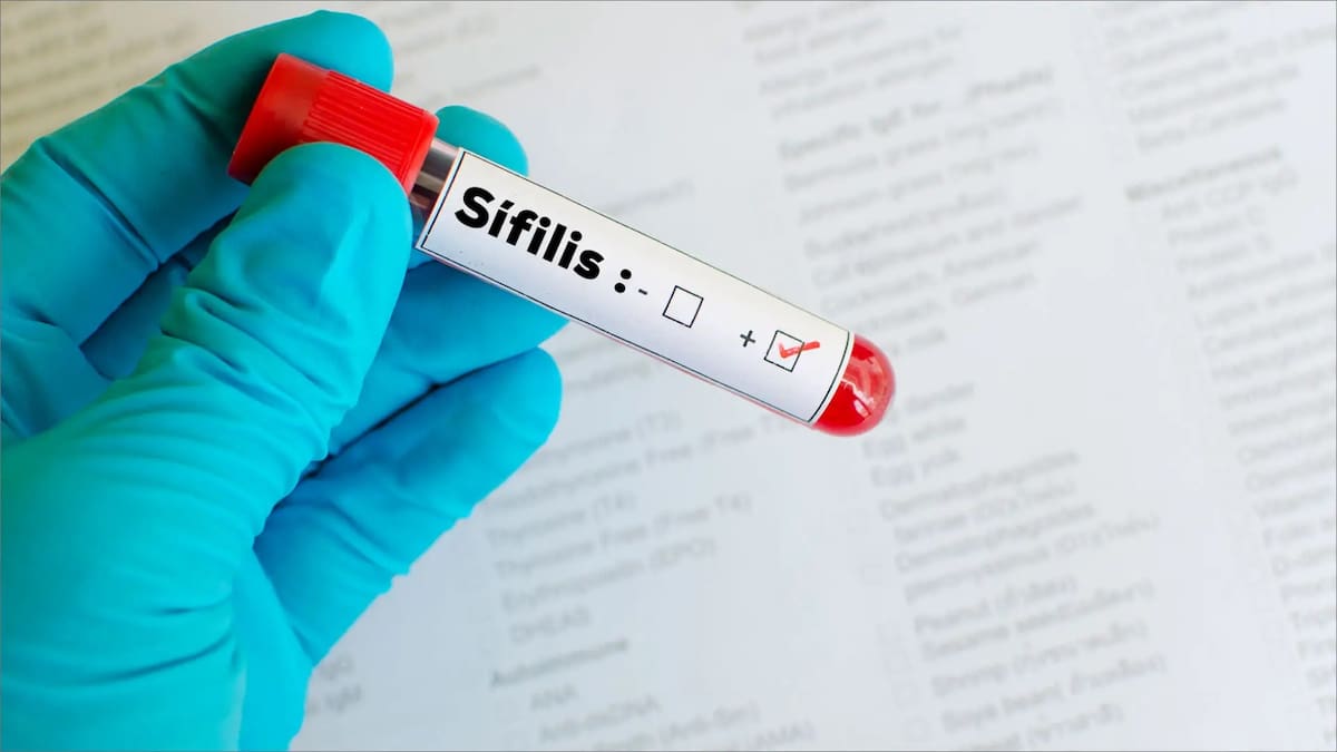 Alerta por sífilis en Argentina