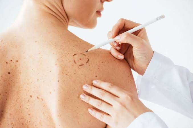 Hoy 23 de mayo, Día Mundial contra el Melanoma