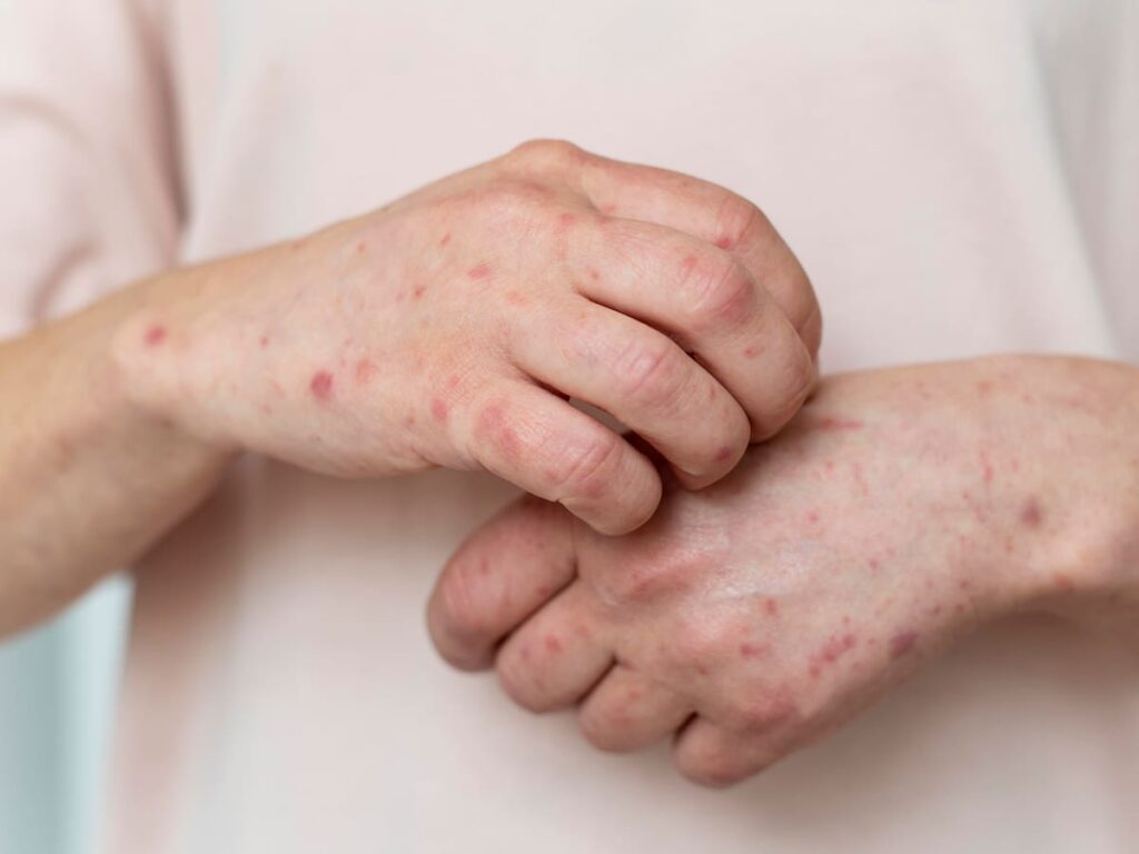 Hoy 14 de septiembre, Día Mundial de la Dermatitis Atópica
