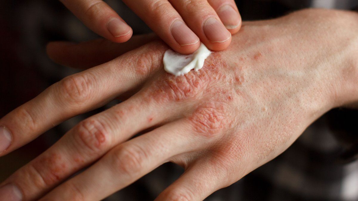 Hoy 29 de octubre, Día Mundial de la Psoriasis